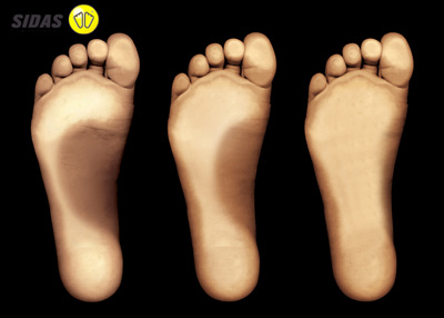 Sidas - 3 feet types